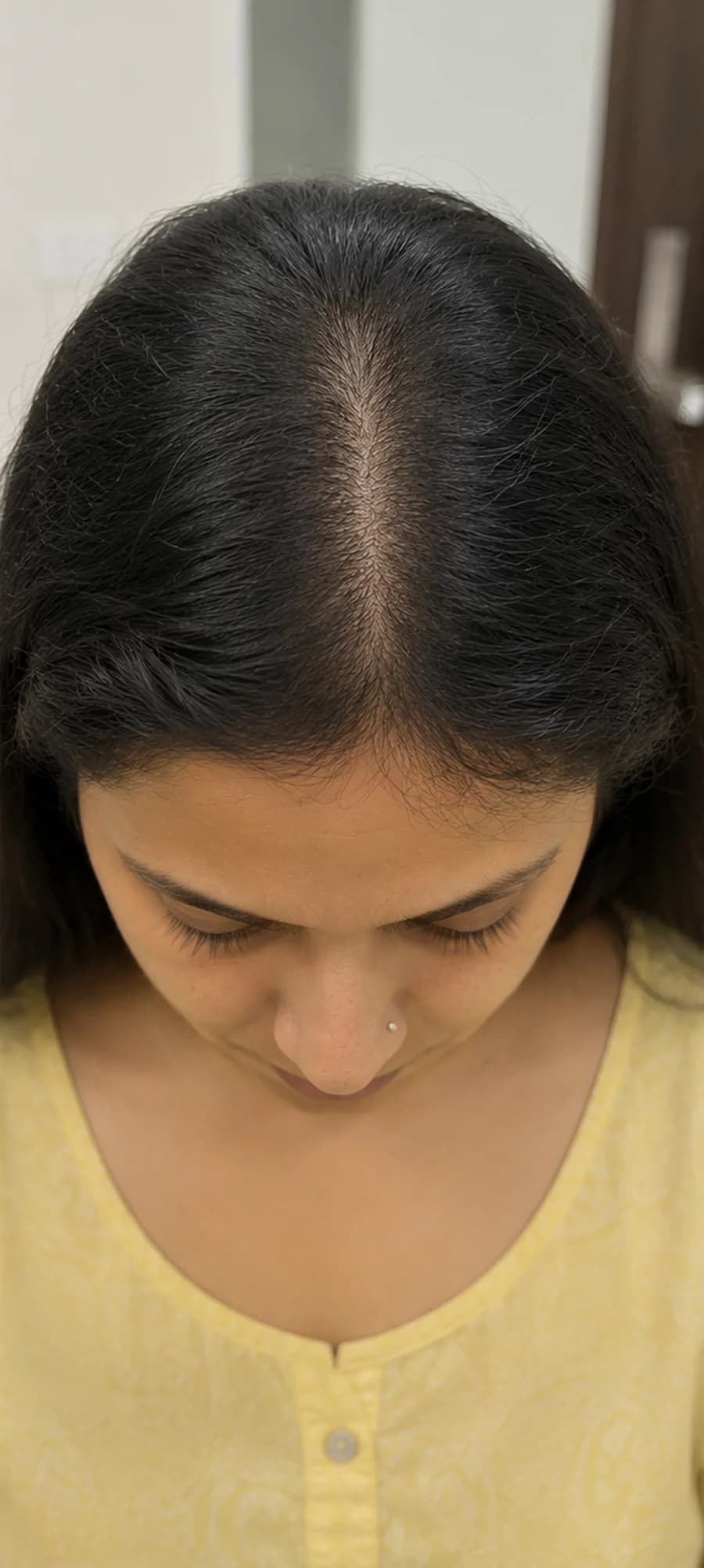 Hair Thinning after treatment