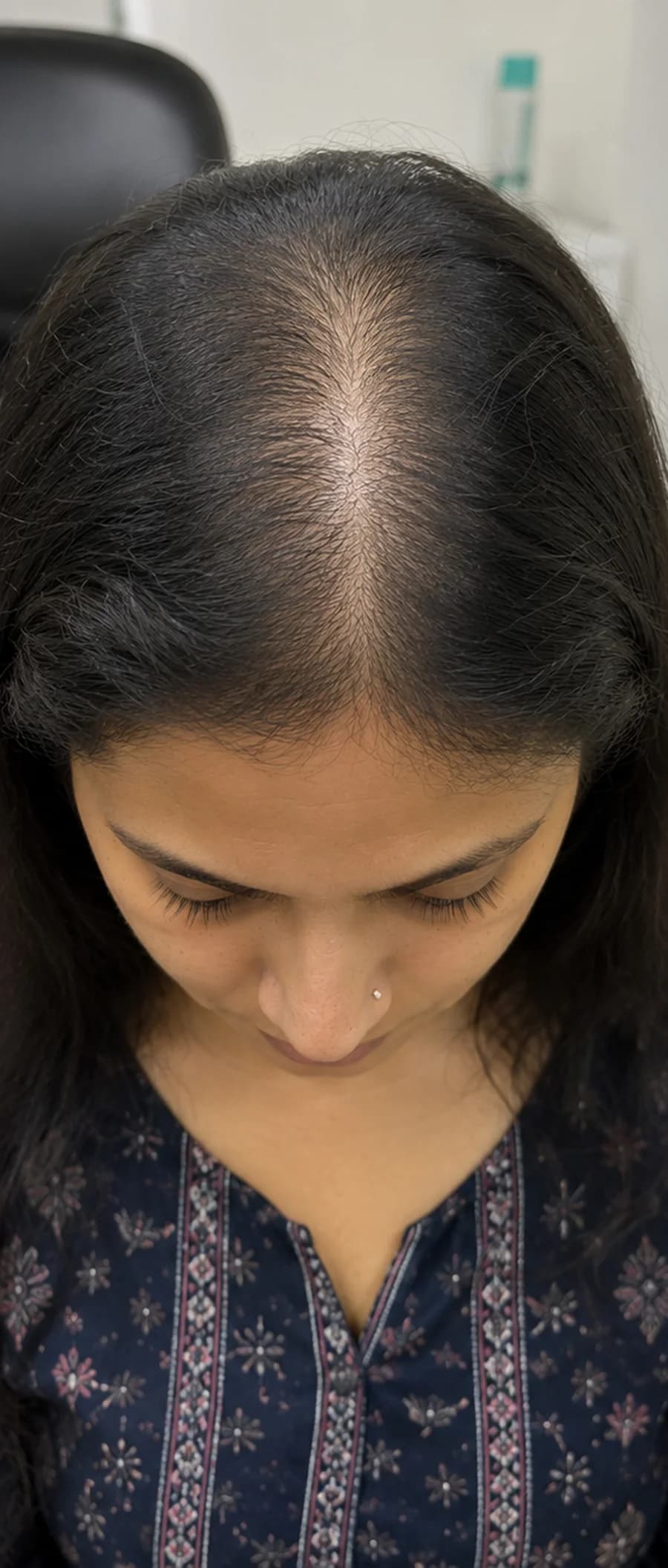 Hair Thinning before treatment