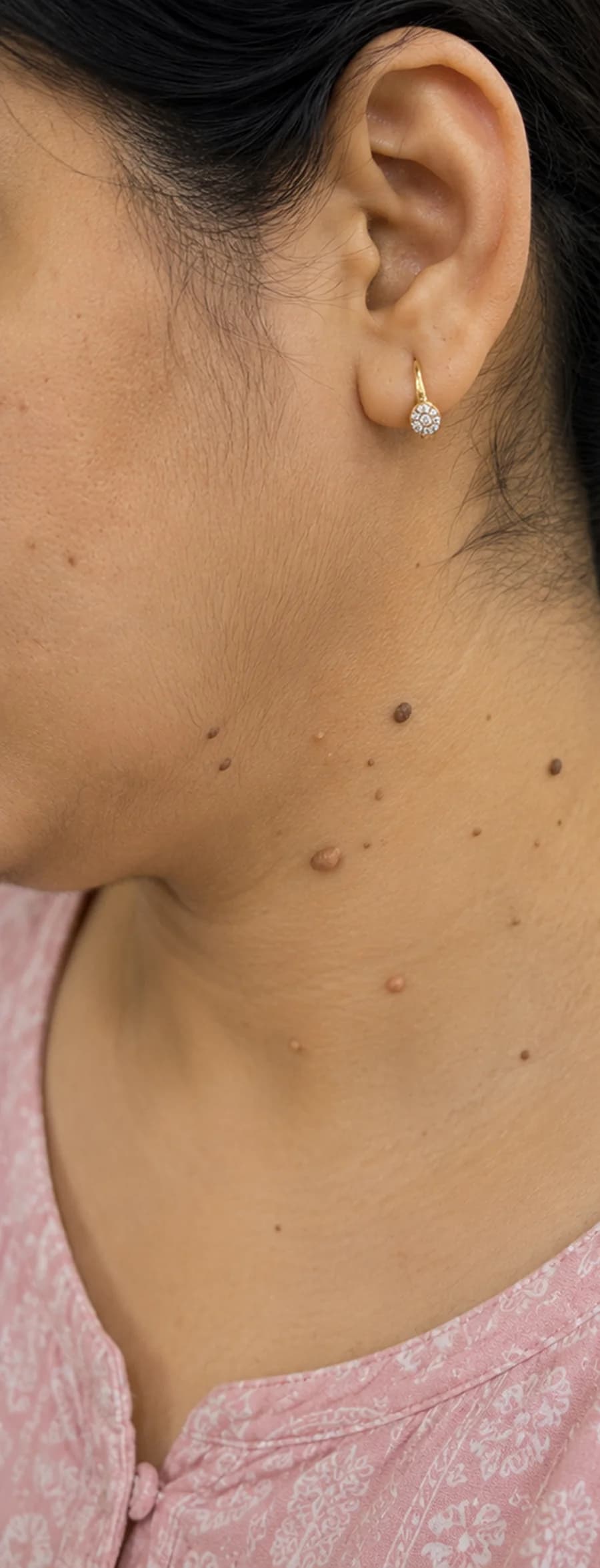 Warts & Skin Tags before treatment